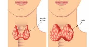 Selenium and Selenium-Dependent Enzymes in Hypothyroidism